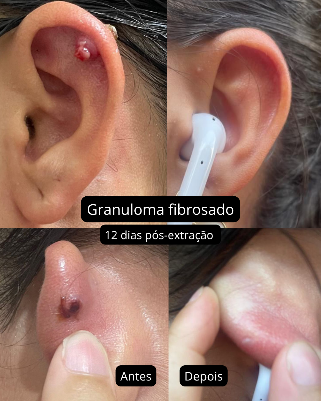Antes e depois de tratamento pós-furo