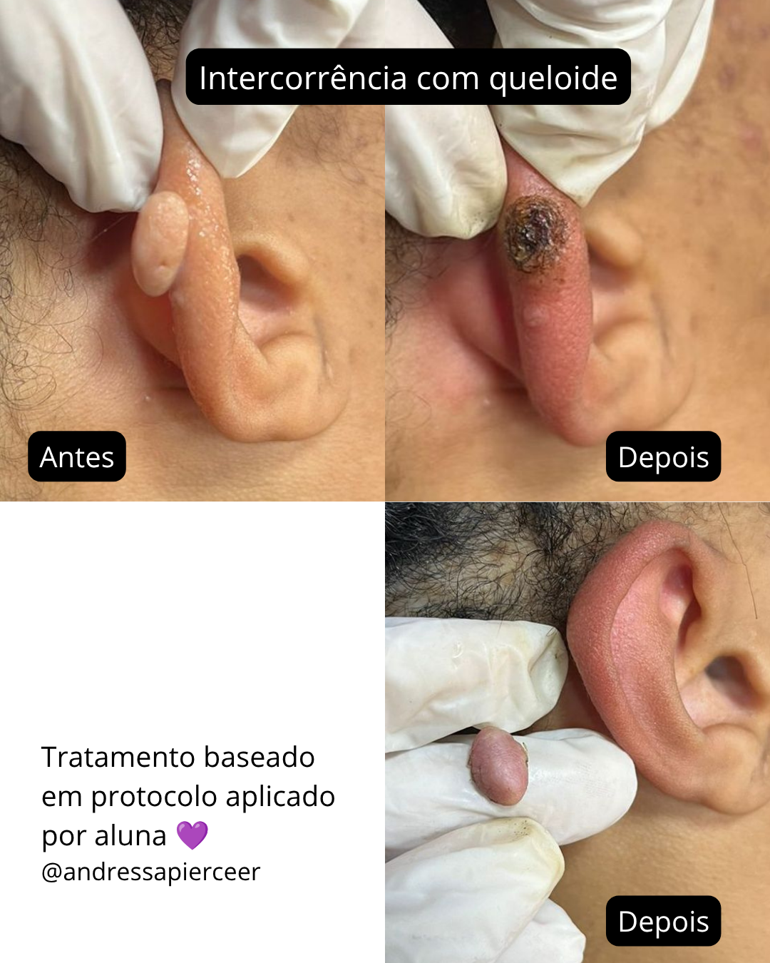 Antes e depois de tratamento pós-furo
