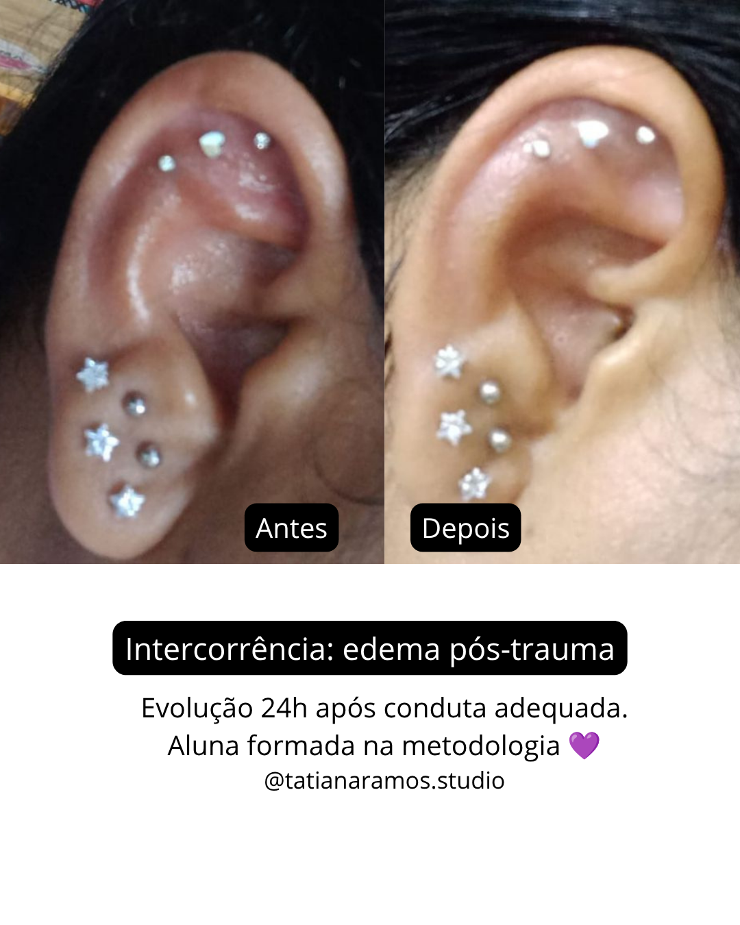 Antes e depois de tratamento pós-furo